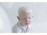 Jenis dan Komplikasi Albinisme