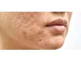 Ini Dia Cara Mengatasi Cystic Acne