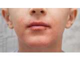 Obat Bibir Bintik Bintik Akibat Herpes Secara Alami dan Medis