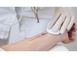 Semuayang Perlu DiketahuiTerkait Metode Laser Tattoo