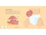 Gejala dan Penyebab Gastroschisis