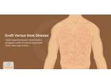 Graft Versus Host Disease, Berbahayakah Bagi Tubuh?